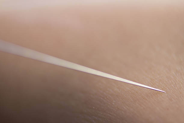 dry needling therapie